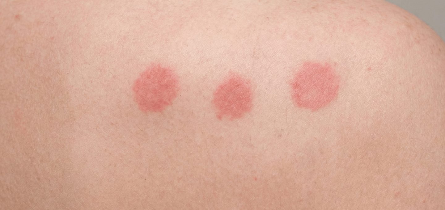 Bed bug bites on human skin in a short row