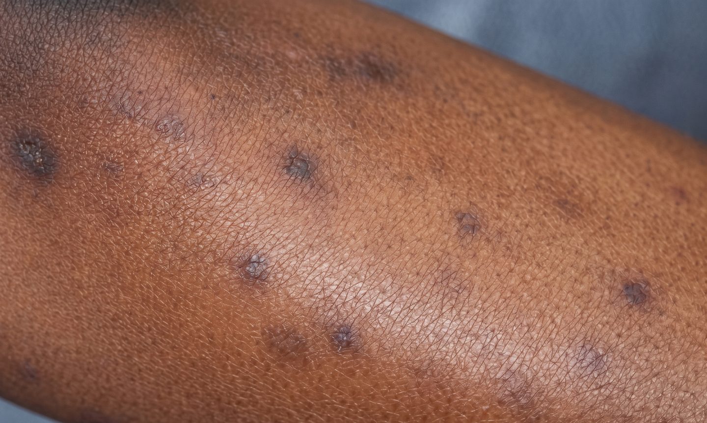 Bed bug bites on black skin shown as raised dark bumps