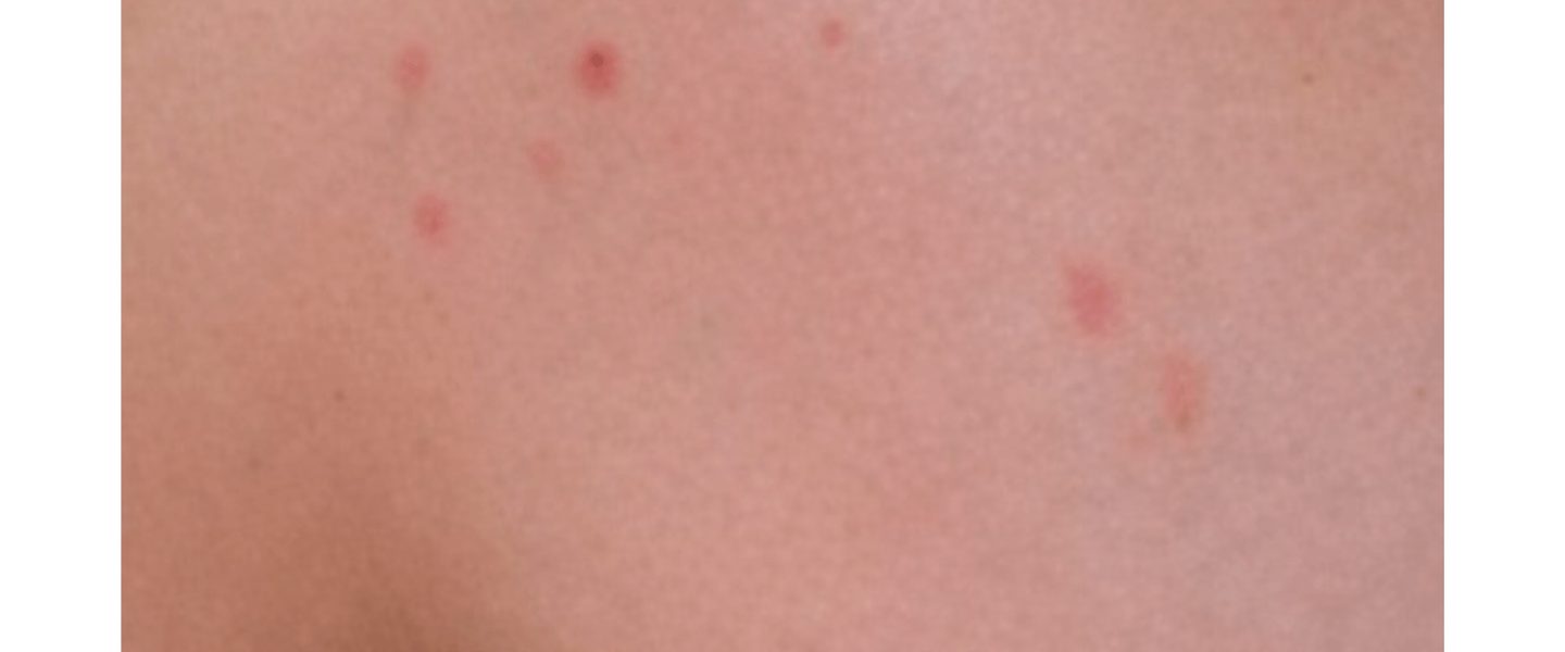 Bed bug bites scattered on skin, shown by body part