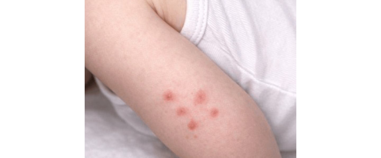 Bed bug bites on an infant's arm