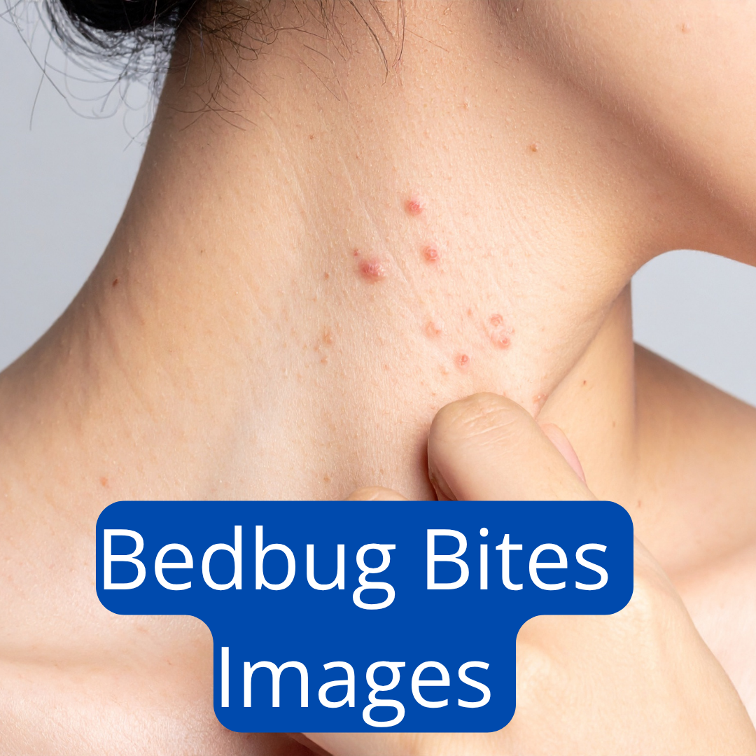 What bed bug bites look like — a cluster of bed bug bites on a person's neck