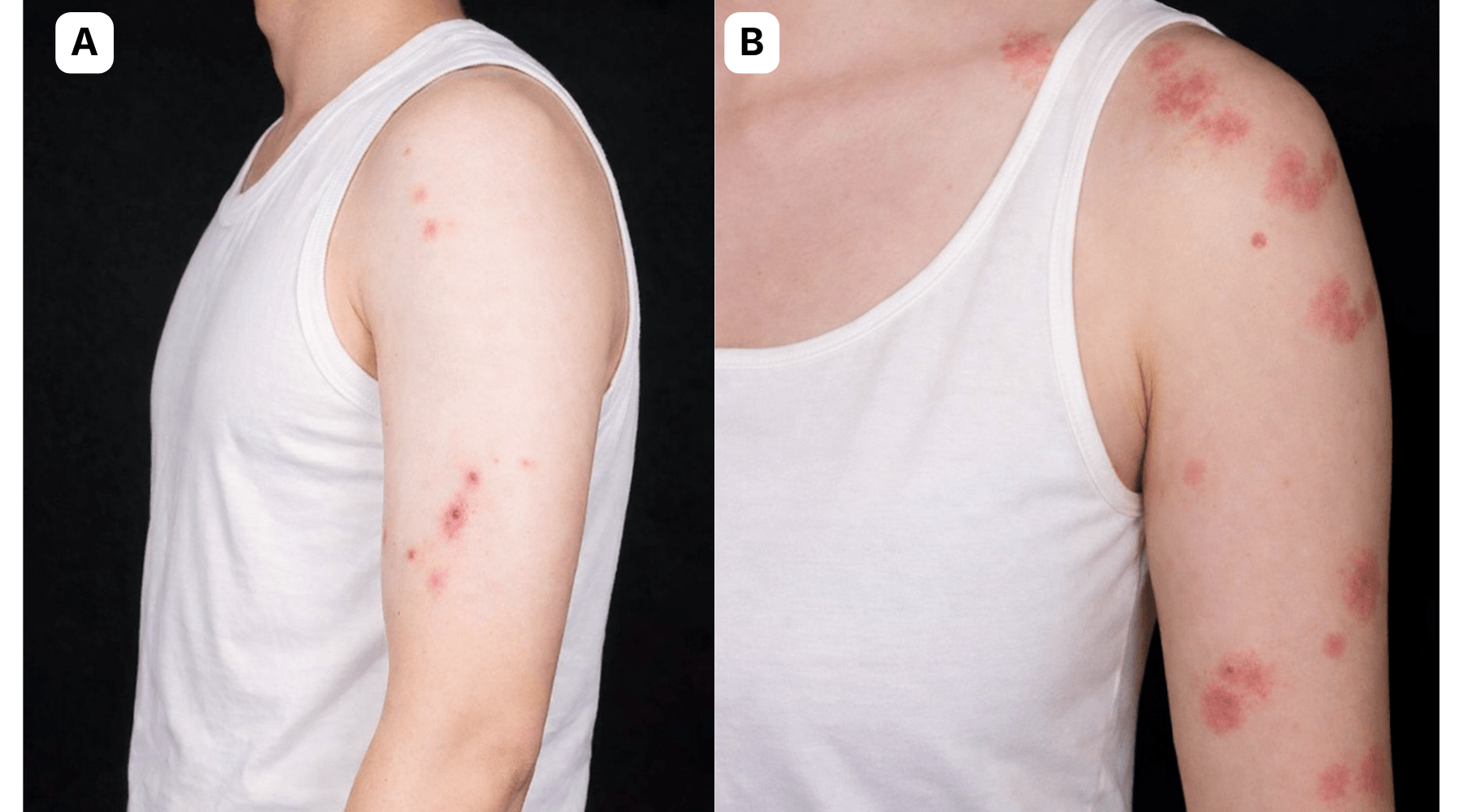 Bed bug bites on a man's upper arm and shoulder, and a stronger reaction on a woman's upper arm and shoulder