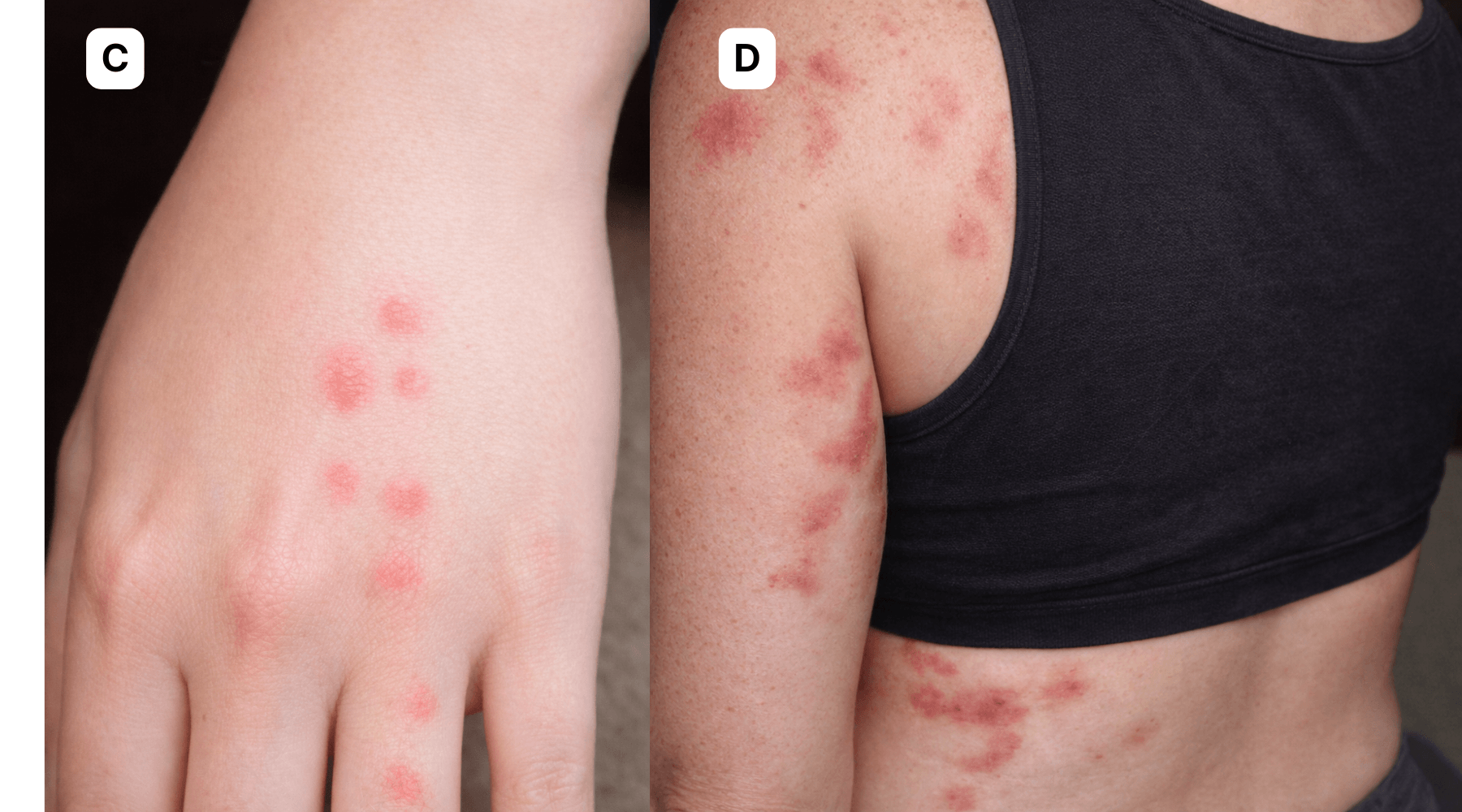 Bed bug bites on a hand and on the back of an upper arm and shoulder