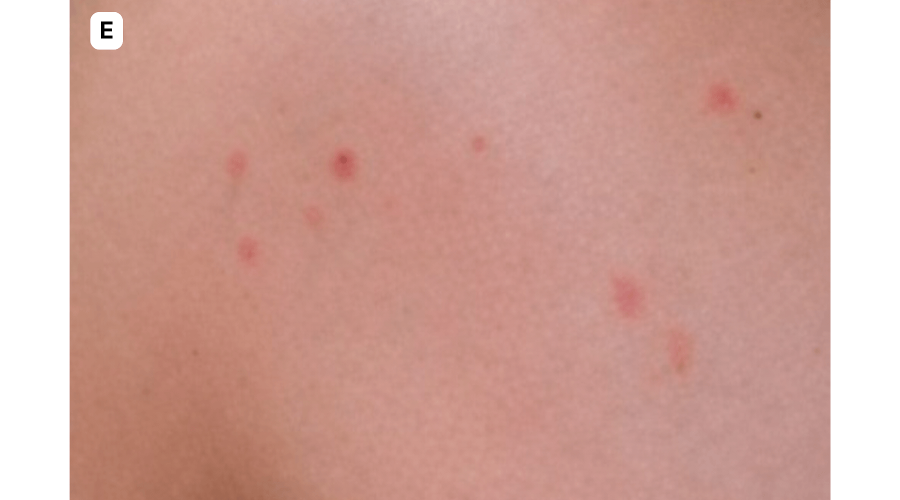 A cluster of bed bug bites on a knee