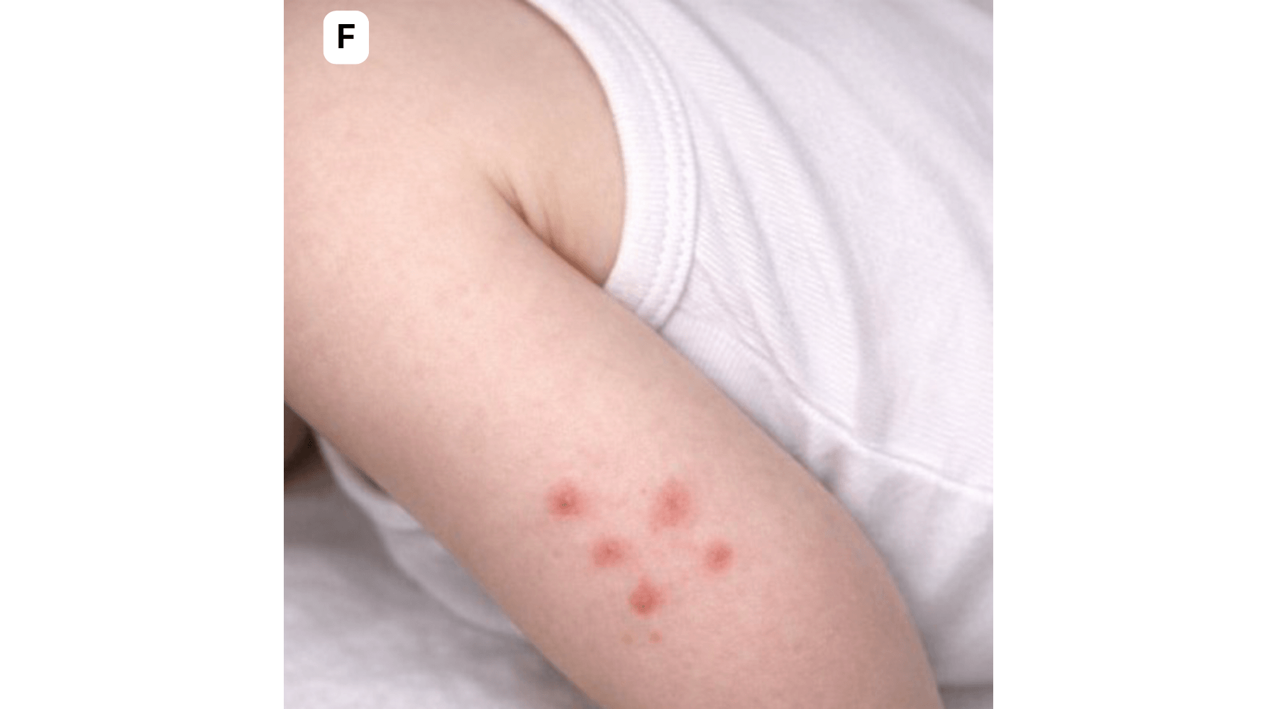 Bed bug bites on a baby's arm shown as small soft red bumps