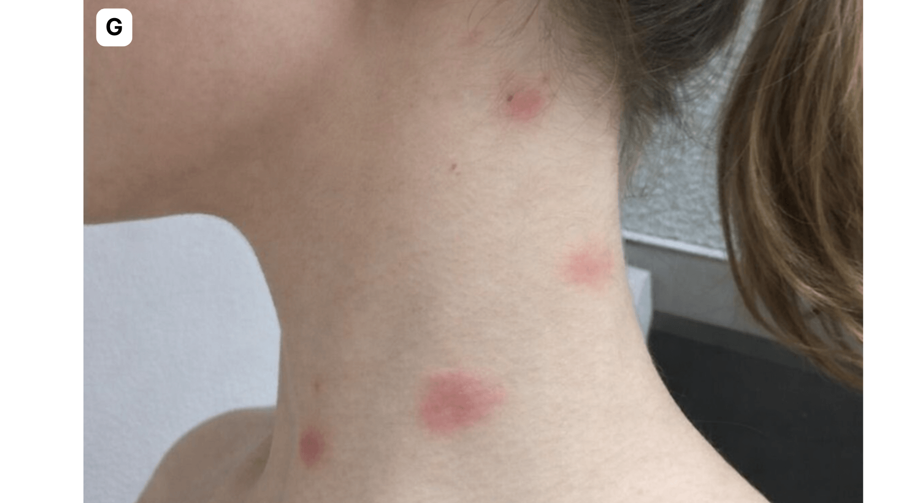A cluster of bed bug bites on the side of a neck