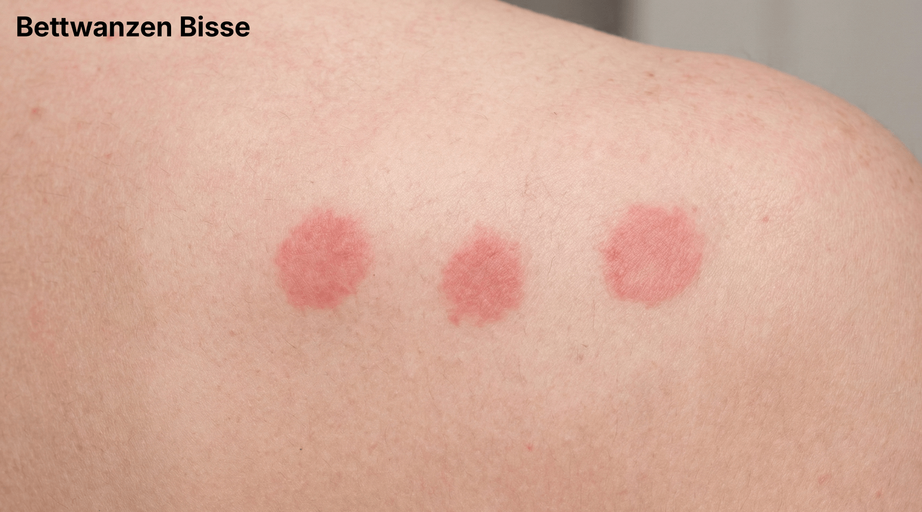 Photo of three bed bug bites in a row on a person's shoulder